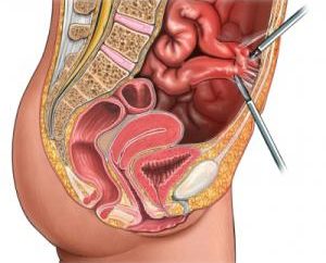 Lo que se lleva a cabo ovarios laparoscopia?