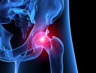 Malattie dell'articolazione dell'anca. I sintomi della patologia dell'anca