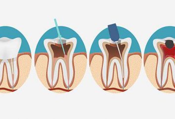 Zahnwurzelkanal: verfügt über Behandlungen, Indikationen