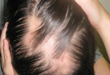 Alopécie – une maladie qui pour? Causes, symptômes, traitement de l'alopécie