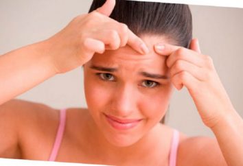 5 consigli efficaci per sbarazzarsi di acne