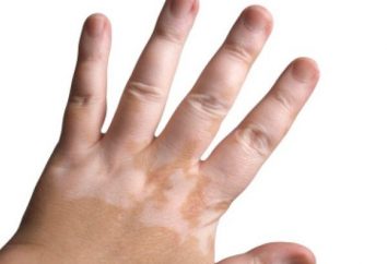 Por que há uma vitiligo criança?