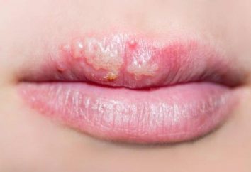 El herpes en los labios: cómo curar todos los remedios caseros? ¿Es posible curar el herpes labial en los labios para siempre?