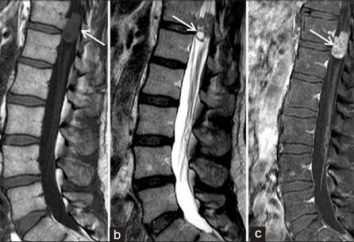 colonna vertebrale di Kaposi: diagnosi e trattamento