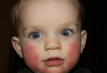 mejillas rojas en bebés: ¿qué hacer? mejillas rojas en los bebés: causas, tratamiento