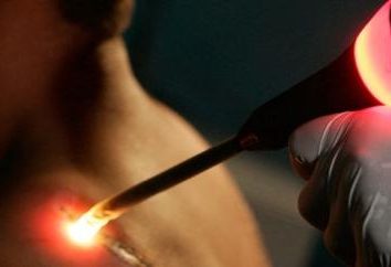 usuwanie tatuażu za pomocą lasera