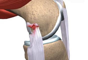 rotura de ligamentos en la pierna: síntomas y tratamiento