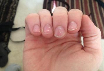 La razón de las manchas blancas en las uñas: cómo deshacerse