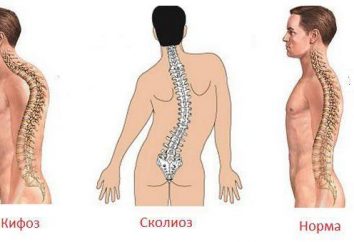 Cifoscoliosi della colonna vertebrale toracica: Tipi e trattamento
