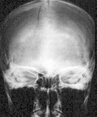 Frattura della base cranica. quadro clinico