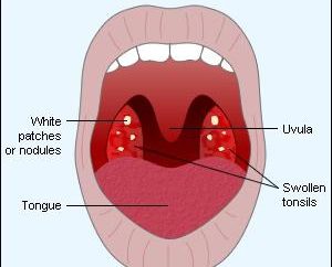 Vacuum lacune lavaggio tonsille. Lavage di lacune di tonsille