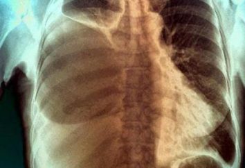 Pleurisia com cancro do pulmão: uma descrição das causas, sintomas e tratamento