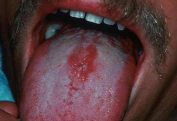 Skuteczne leczenie zapalenie języka