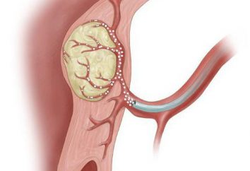 embolizzazione dell'arteria uterina per uterina trattamento mioma e conseguenze