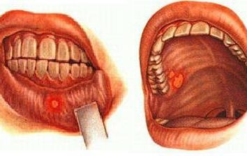 Malattie della cavità orale negli adulti. Malattie della cavità orale e del loro trattamento