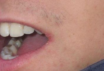 Jak leczyć perleches usta w kącikach popularnych sposobów i używanie narkotyków