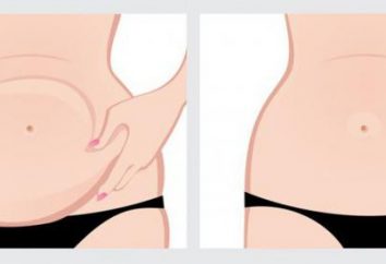 Abdominoplastia (abdominoplastia): indicações, contra-indicações, a descrição do procedimento, comentários