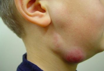 Linfoadenite nei bambini: cause, sintomi e trattamento