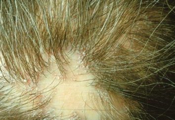 Zoster sulla testa: i tipi principali, sintomi e trattamento