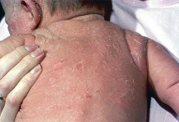 dermatite esfoliativa negli adulti e nei neonati (foto)