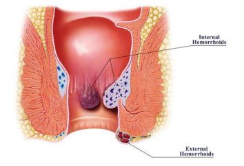 Emorroidi: cause negli uomini, i sintomi e le caratteristiche di trattamento