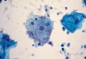 Naruszenie mikroflory pochwy: przyczyny i objawy