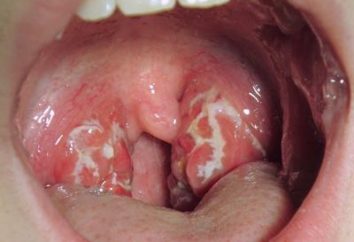 Streptocoque dans la gorge: symptômes, causes et traitement