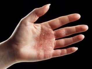Sinister zapalenie skóry na rękach: leczenie