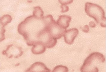 Causas e tratamento de eczema pomada microbiana, fotos