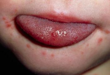 Wysypka na ustach dziecka: Jakie choroby przyczyną?