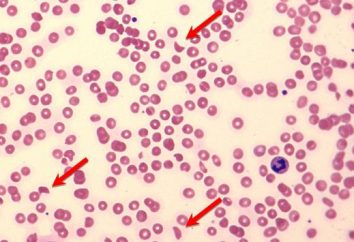 Patológico sangue hemólise: causas, sintomas e tratamentos