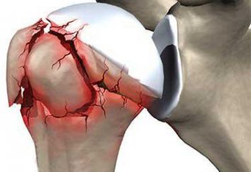 cuello fractura del hombro: causas, síntomas, diagnóstico y tratamiento