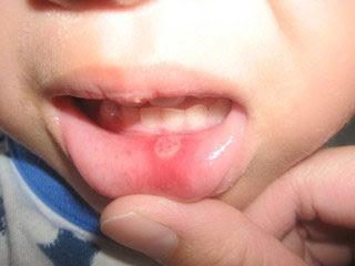 Comment guérir stomatite dans la bouche? Stomatite: prévention, traitement, remèdes populaires