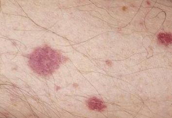 Vaskulitis – eine Läsion des Blutgefäßwände