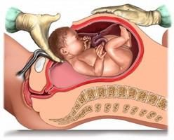 cesárea: recuperación después del parto y posterior pronóstico