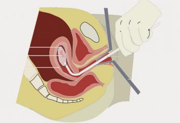 Alocação após a biópsia do colo do útero: norma e patologia