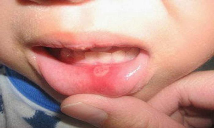 Dans la bouche, l'acné: causes et traitements