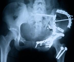 frattura dell'anca negli anziani: conseguenze possono essere irreversibili