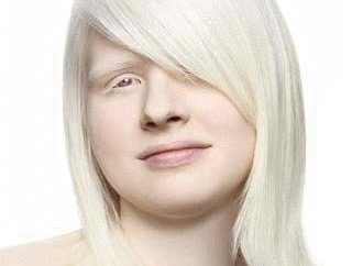 Albinosy – w … bielactwo – wrodzona nieobecności barwnika melaniny