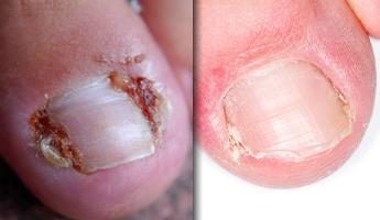 Wrastanie paznokci na nodze: przyczyny i leczenie