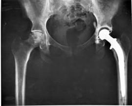 Lorsque vous avez besoin d'une articulation de la hanche de remplacement, et les conséquences pourraient être dans cette opération?