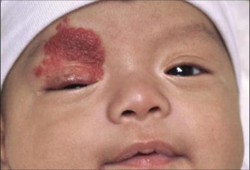 hemangiomas láser de eliminación en niños y adultos: contraindicaciones y cuidado después del procedimiento
