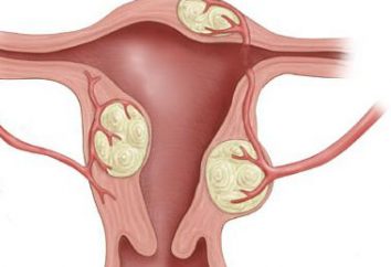 Los signos y síntomas de los fibromas uterinos: ¿cómo reconocer la enfermedad