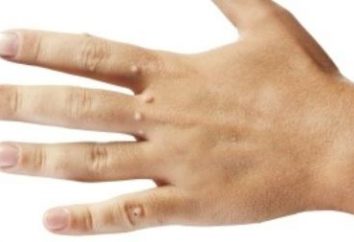 ¿Cómo deshacerse de las verrugas en las manos: las técnicas básicas