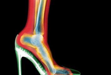 Leczenie stożków na nogach kciukiem bez chirurgii