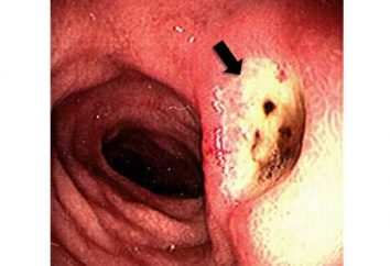 Trattamento e sintomi di ulcere gastriche e duodenali 12 ulcera