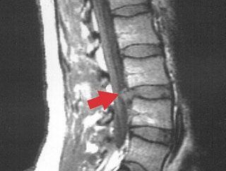 ernia del disco spinale