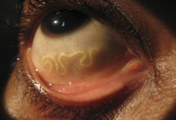 Was sind Parasiten im menschlichen Auge?