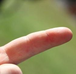 Wie man den Splitter aus dem Finger herausziehen? gute Ratschläge