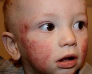 Como doenças de pele em crianças